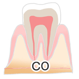 川上歯科あべの診療所 虫歯の進行度CO
