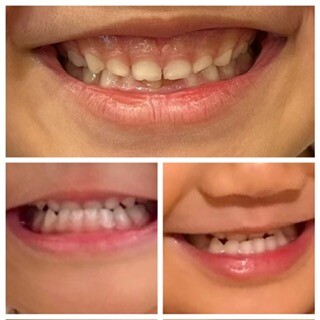 小児矯正治療の症例