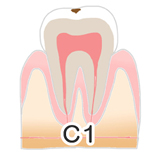 川上歯科あべの診療所 虫歯の進行度C1