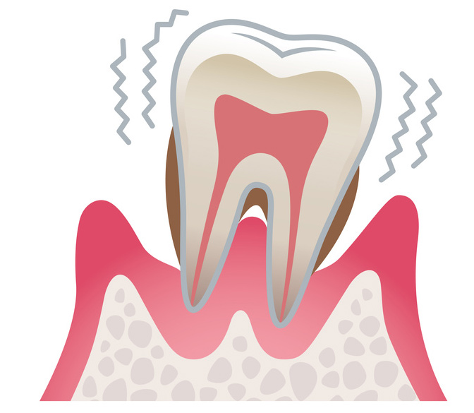 川上歯科あべの診療所 重度の歯周炎