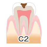 川上歯科あべの診療所 虫歯の進行度C2