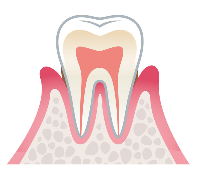 川上歯科あべの診療所 軽度の歯周炎